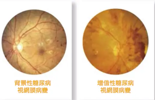 糖尿病視網膜病變